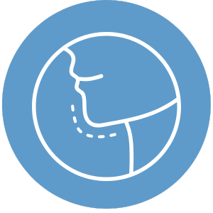 Mentoplastia