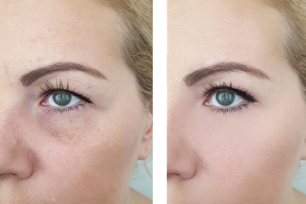 especialista en blefaroplastia en Guadalajara