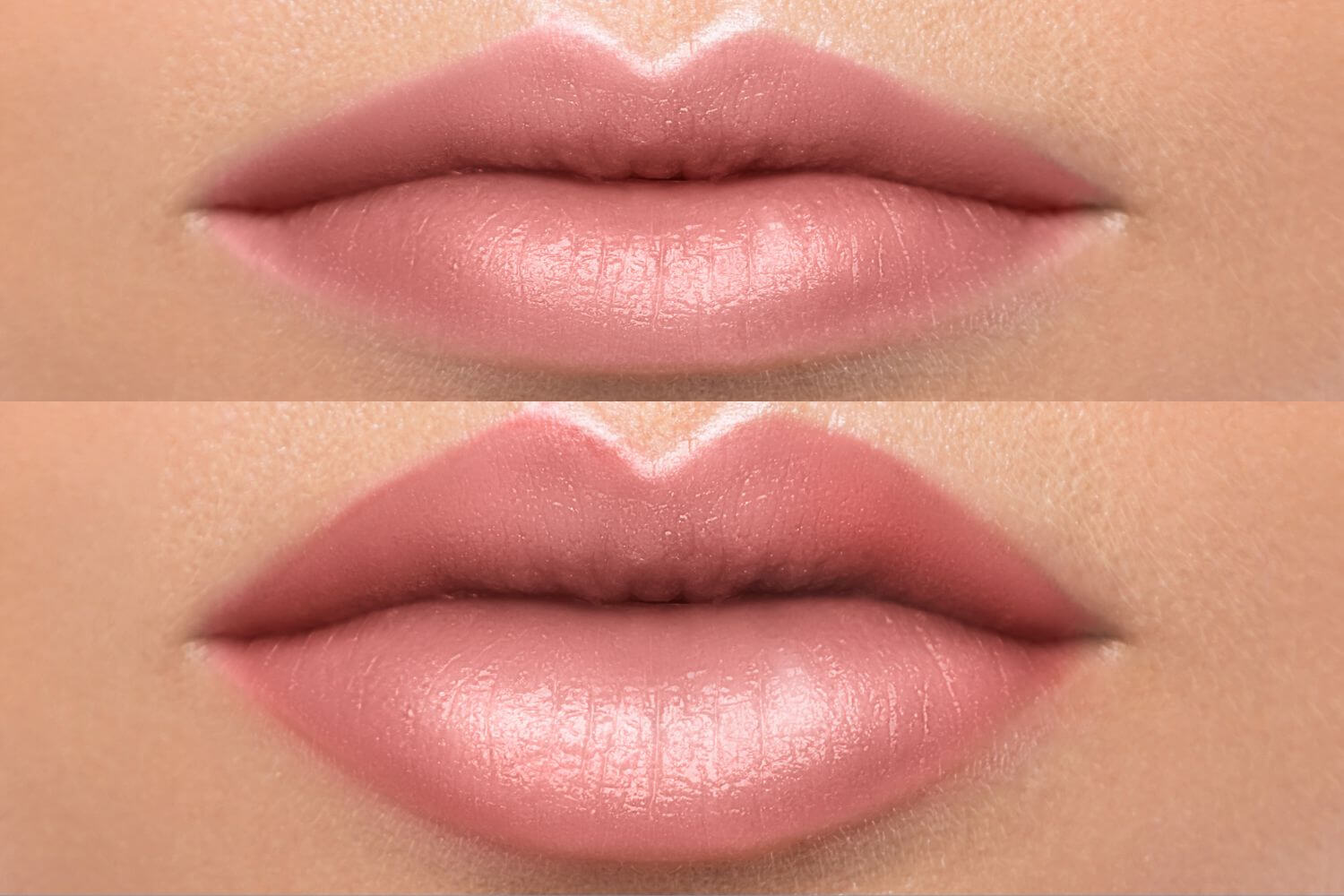Imagen destacada Guia sobre lifting de labios