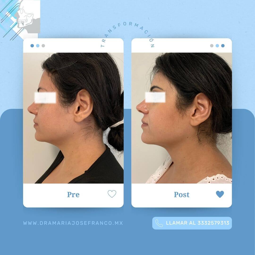 LIPOPAPADA 1