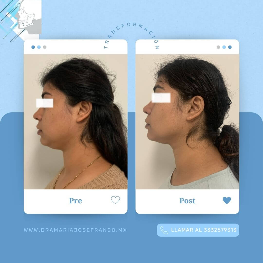 LIPOPAPADA 2