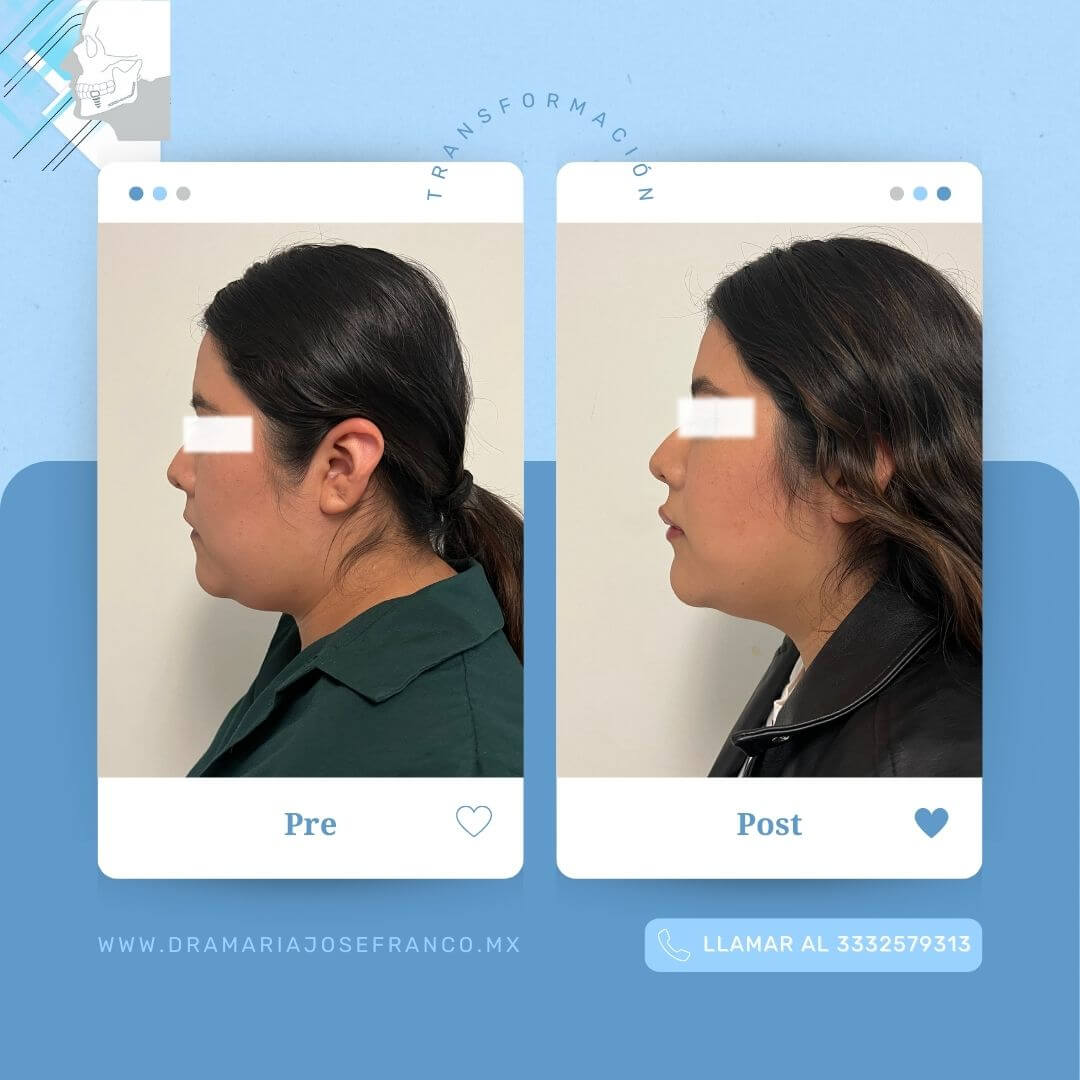 LIPOPAPADA 3