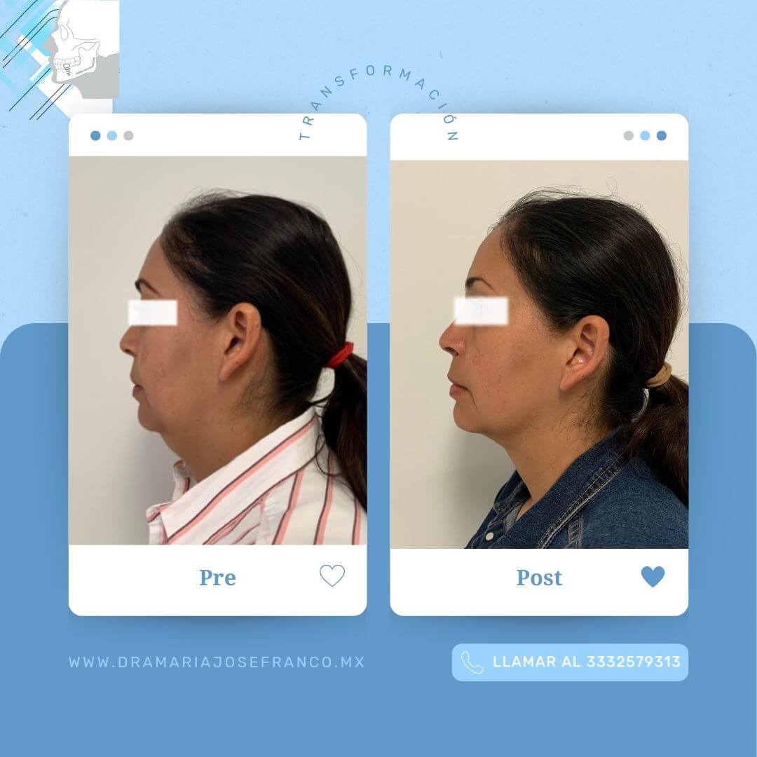LIPOPAPADA 4