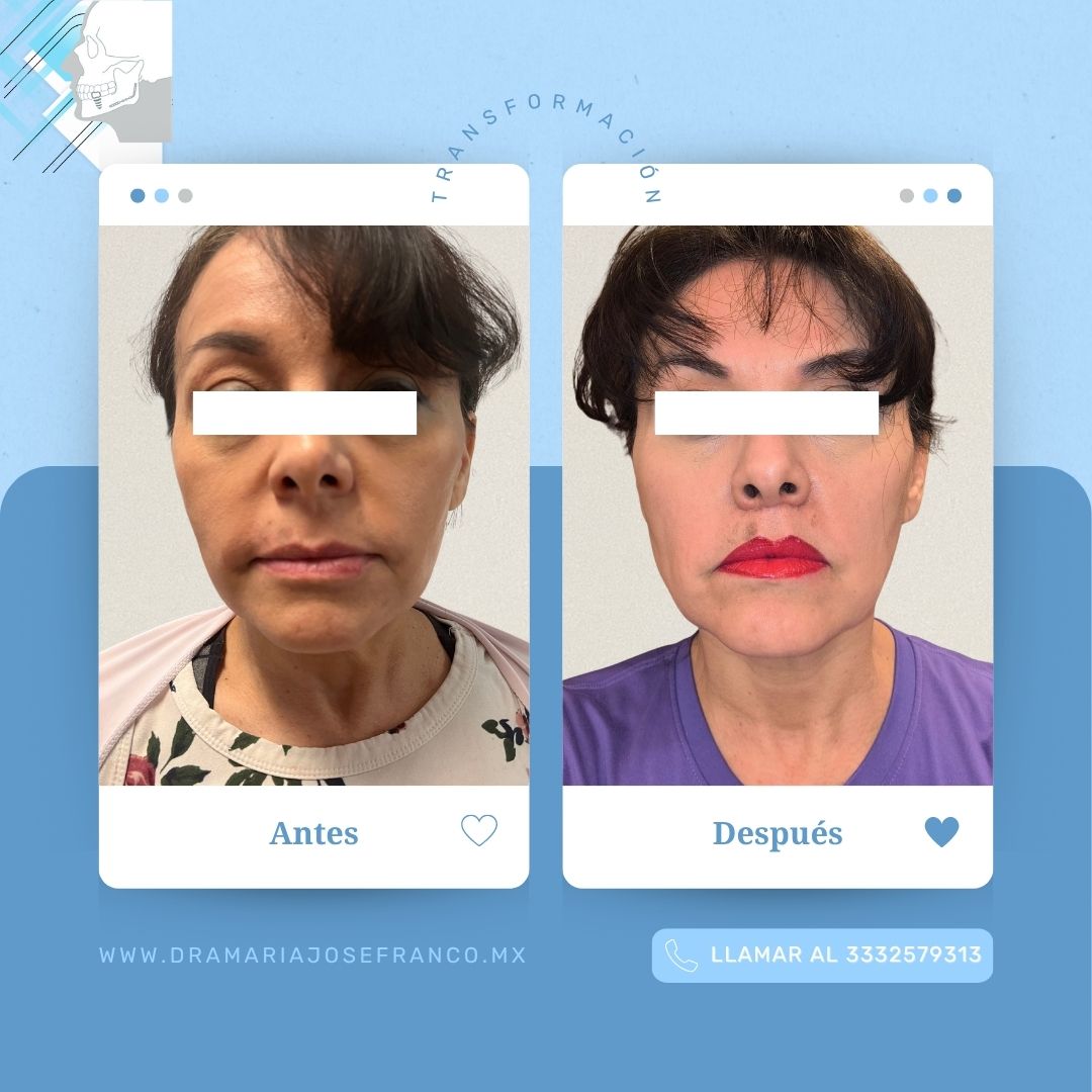 Antes y despues vertical LIP LIFT 1 ABRIL2026