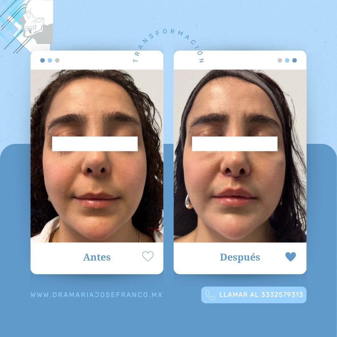 Antes y despues vertical LIP LIFT 2 ABRIL2026