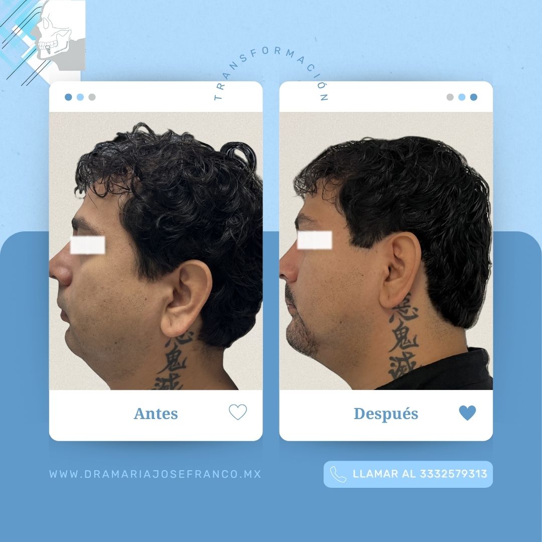 Antes y despues vertical MENTOPLASTIA 1 ABRIL2026