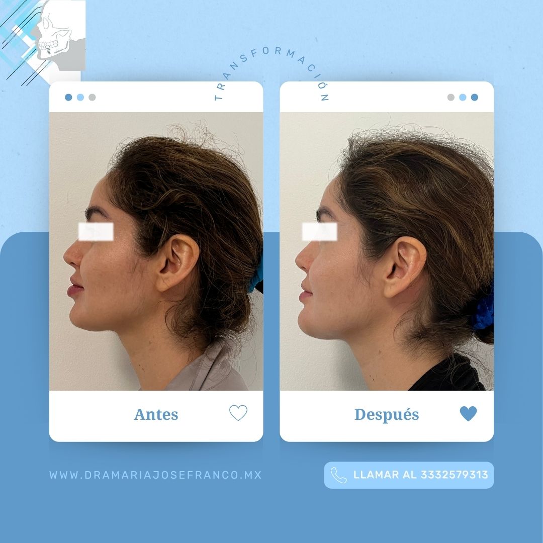 Antes y despues vertical MENTOPLASTIA 2 ABRIL2026