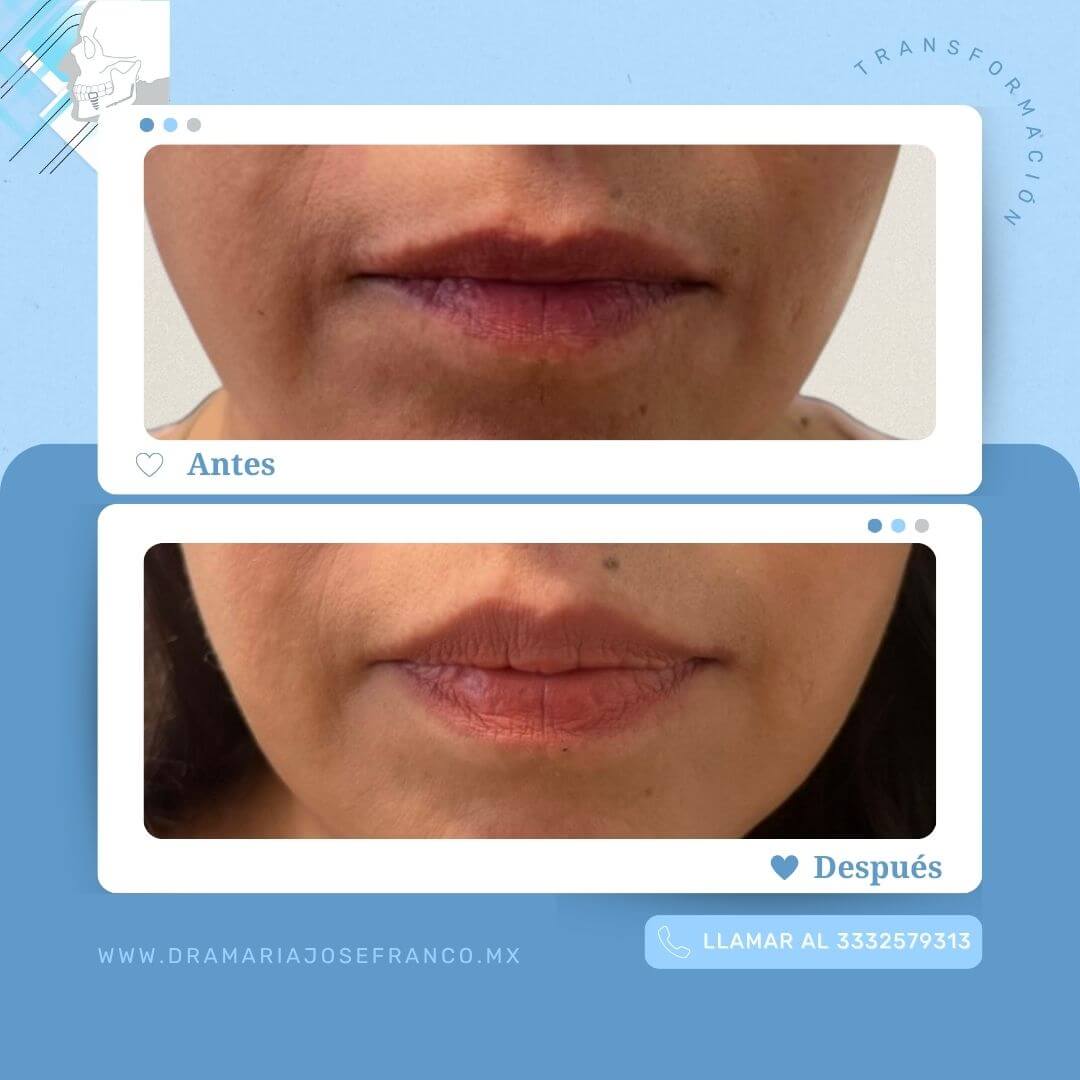 Antes y despues horizontal Lip Lift Hiram
